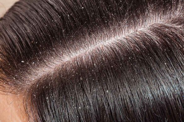 Seboreik Dermatit Nedir? Belirtileri Nelerdir?
